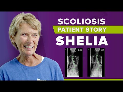 Adult Scoliosis Pain &amp; Lower Lumbar Scoliosis Reduction: Shelia&#039;s Story