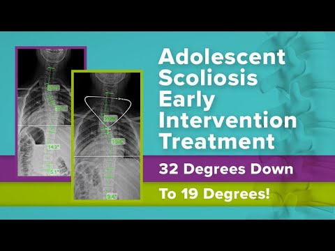 Adolescent Scoliosis Early Intervention Treatment: 32 Degrees Down To 19 Degrees!