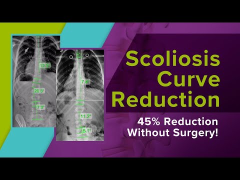 Scoliosis Curve Reduction: 45% Reduction Without Surgery