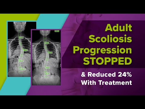 Adult Scoliosis Progression STOPPED &amp; Reduced 24% With Treatment