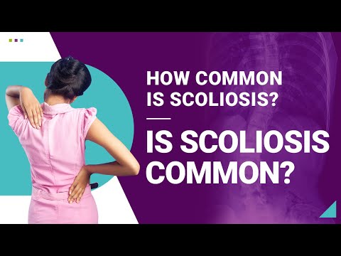 How Common is Scoliosis? Is Scoliosis Common?