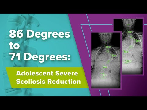 86 Degrees to 71 Degrees: Adolescent Severe Scoliosis Reduction