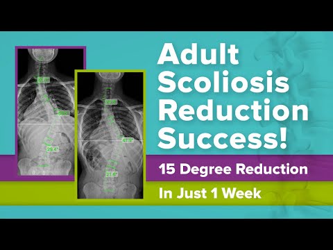 Adult Scoliosis Reduction Success! 15 Degree Reduction In Just 1 Week