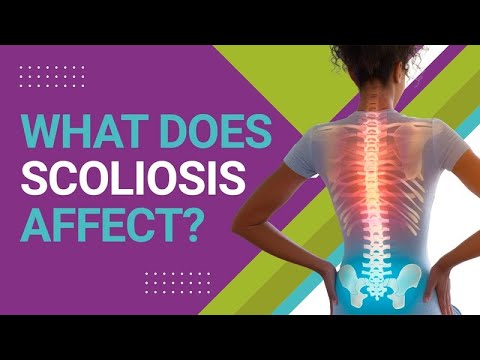 What Does Scoliosis Affect?