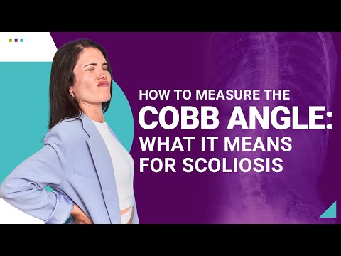 How to Measure the Cobb Angle: What It Means for Scoliosis