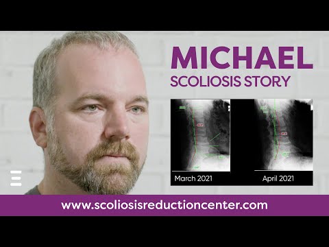 Adult Scoliosis Alternative Treatment Without Surgery, Michael&#039;s Story