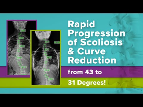 Rapid Progression of Scoliosis &amp; Curve Reduction from 43 to 31 Degrees!