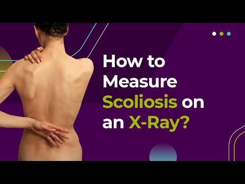 How to Measure Scoliosis on an X-Ray?