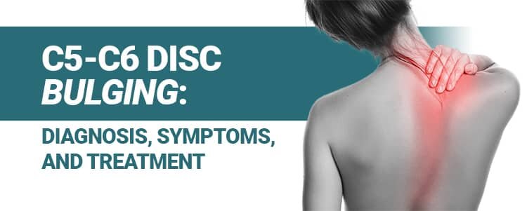 C5-C6 Disc Bulging: Symptoms, and Treatment