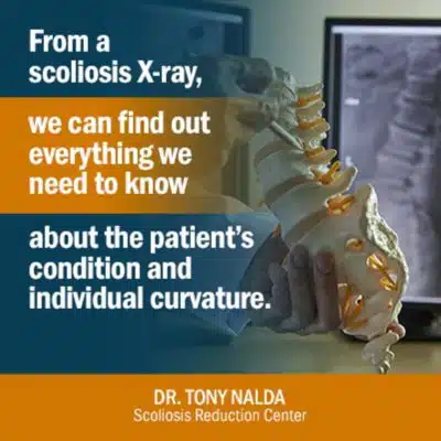 https://www.scoliosisreductioncenter.com/wp-content/uploads/2020/12/from-a-scoliosis-small-e1606943946647.jpg.webp