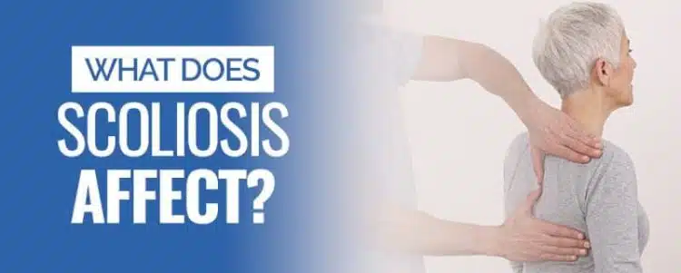 what does scoliosis affect