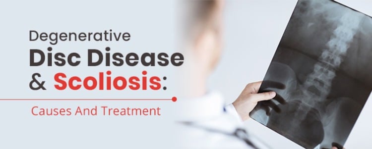 Degenerative Disc Disease Causes & Treatment