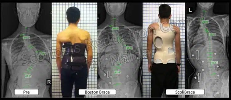 ComparisonBostonBraceNew