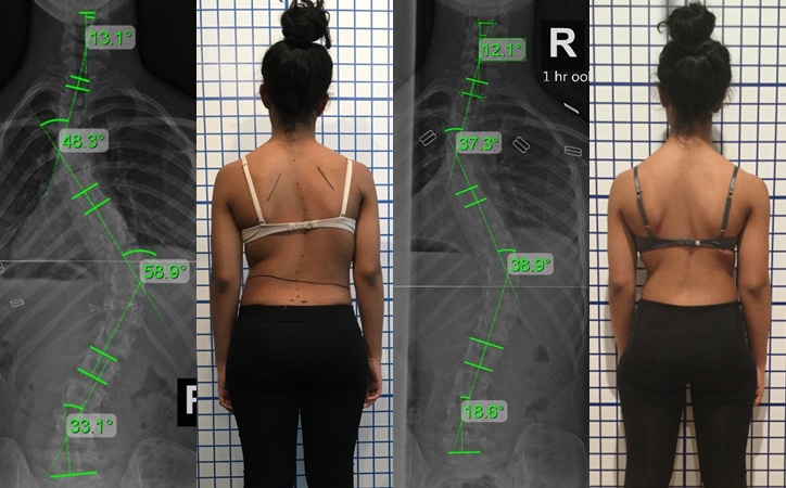 adolescent severe scoliosis 4