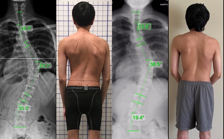 adult severe scoliosis 4