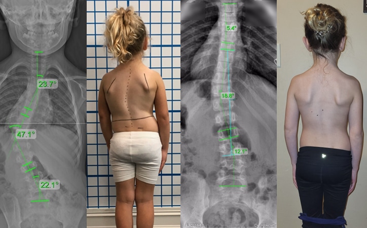 juvenile severe scoliosis 1