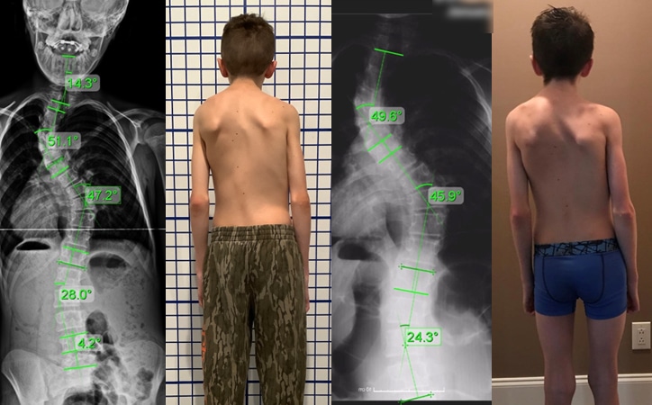 juvenile severe scoliosis 4