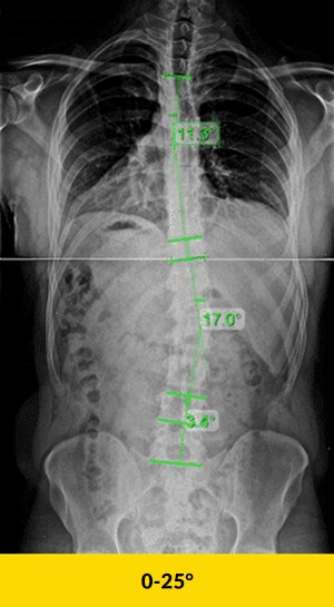 mild scoliosis xray2