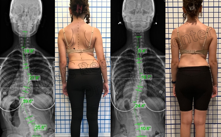 adolescent moderate lumbar 1