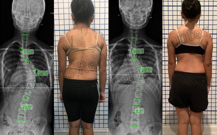 adolescent moderate lumbar 2