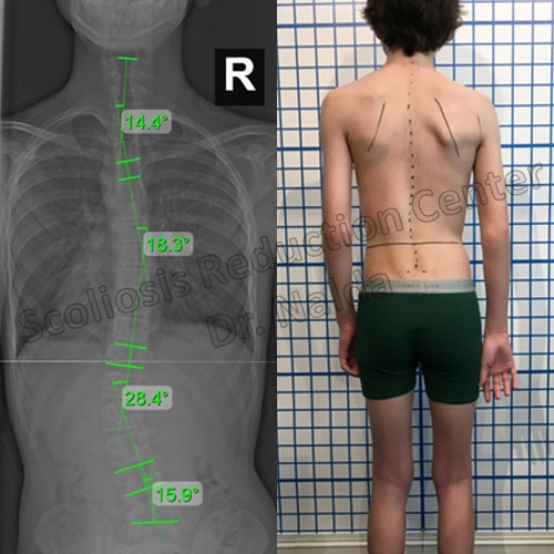 adolescent neuromuscular