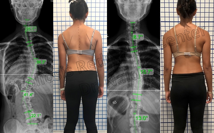 adolescent severe lumbar 1