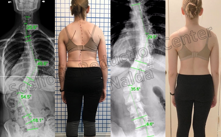 adult severe lumbar 1