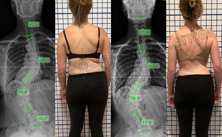 adult severe lumbar 2