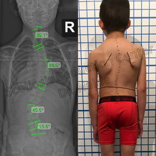 juvenile congenital