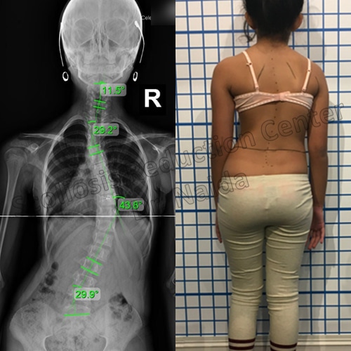 juvenile idiopathic