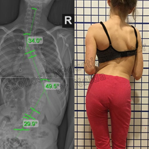 juvenile neuromuscular